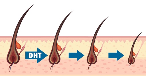 Wpływ DHT na mieszek włosowy